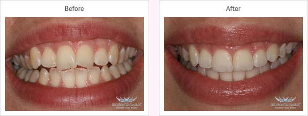 Six month smile before and after case 1 Kent