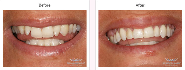 Six month smile before and after case 5 Kent
