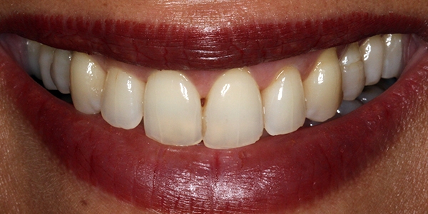 After Invisalign Treatment Reading Smiles 