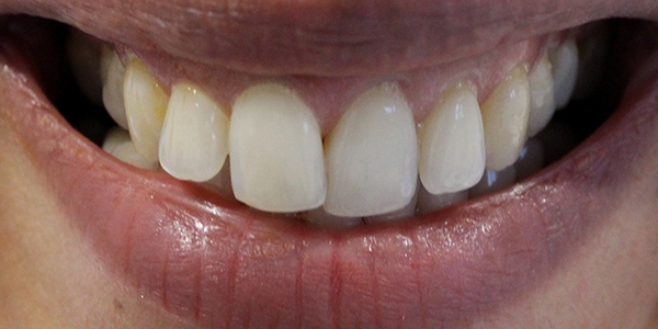 Before Invisalign Treatment Reading Smiles 