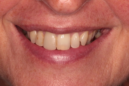 Before Smile Makeover Treatment Smile Rooms 