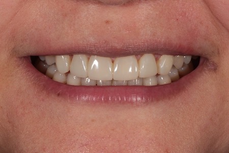 After Smile Makeover Treatment Smile Rooms 