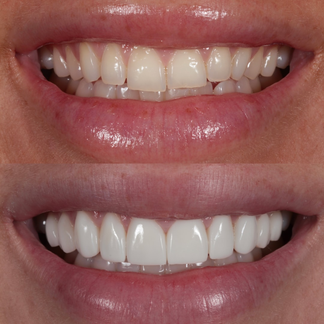 Before & After Cosmetic Bonding, Smile Rooms