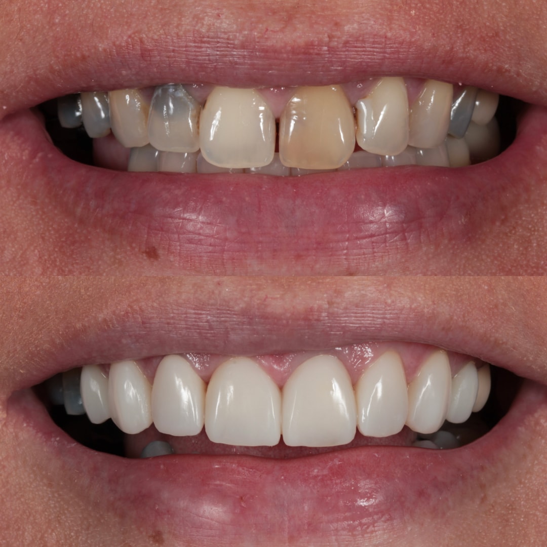 Before & After Cosmetic Bonding | Smile Rooms | Smile Gallery