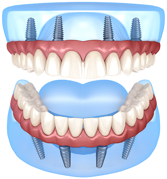 All On 4 Dental Implants Windsor