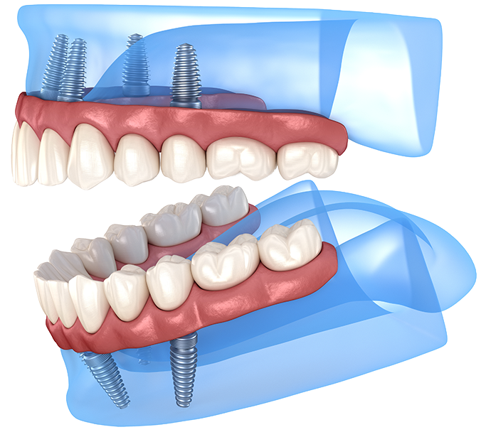 dental implants Maidenhead