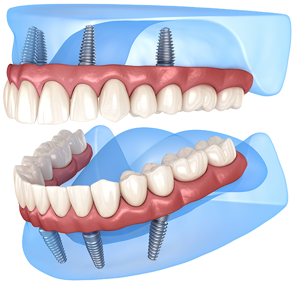 Same Day Teeth Windsor With Dental Implants