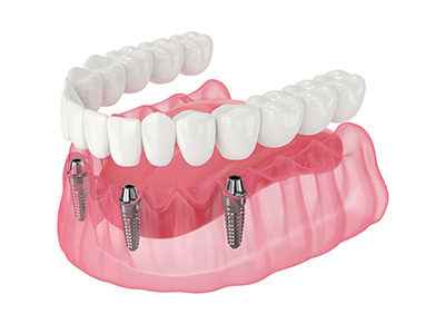 dental implant Milton Keynes