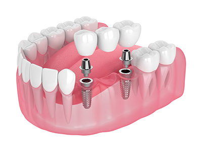 dental implant Milton Keynes