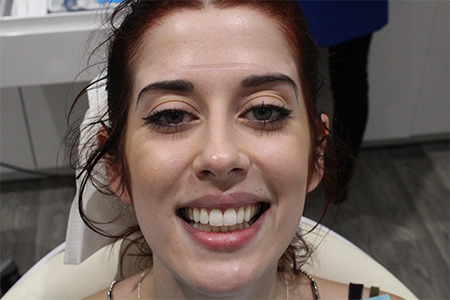 reading-smiles-bonding-whitening-shaping-a1-1