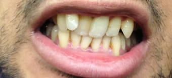 Before and After Invisalign Treatment Windsor Before and After Invisalign Treatment Windsor