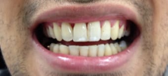 Before and After Invisalign Treatment Windsor Before and After Invisalign Treatment Windsor