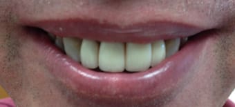 Before and After Invisalign Treatment Windsor Before and After Invisalign Treatment Windsor