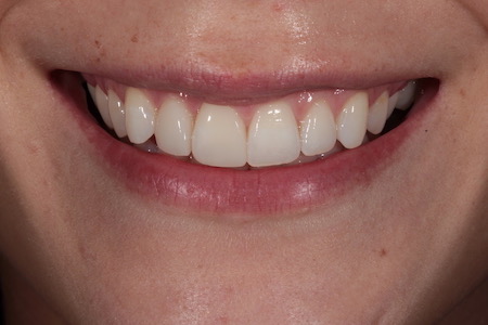 After Invisalign Treatment Reading Smiles