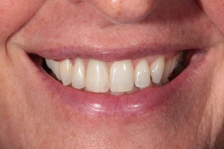 Before and After Invisalign Treatment Windsor Before and After Invisalign Treatment Windsor
