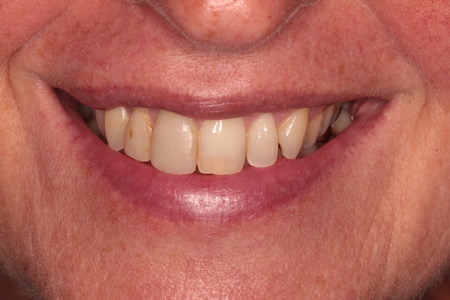 Before and After Invisalign Treatment Windsor Before and After Invisalign Treatment Windsor