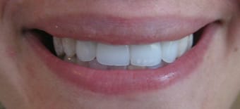 Before and After Invisalign Treatment Windsor Before and After Invisalign Treatment Windsor
