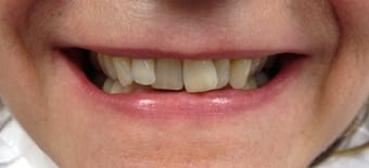 Before and After Invisalign Treatment Windsor Before and After Invisalign Treatment Windsor