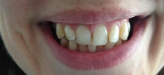 Before and After Invisalign Treatment Windsor Before and After Invisalign Treatment Windsor