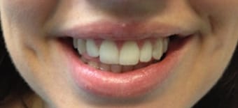 Before and After Invisalign Treatment Windsor Before and After Invisalign Treatment Windsor