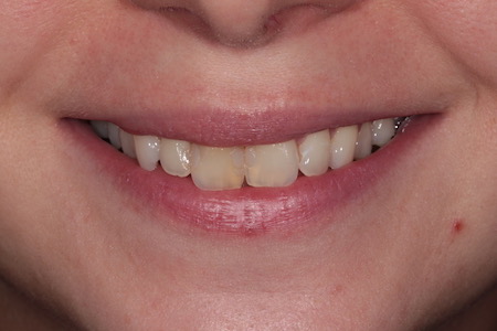 Before and After Invisalign Treatment Windsor Before and After Invisalign Treatment Windsor