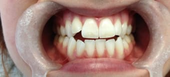 Before and After Invisalign Treatment Windsor Before and After Invisalign Treatment Windsor