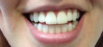 Before and After Invisalign Treatment Windsor Before and After Invisalign Treatment Windsor