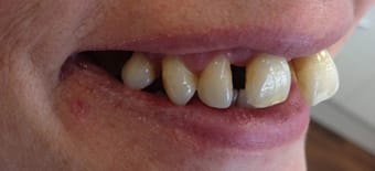 Before and After Invisalign Treatment Windsor Before and After Invisalign Treatment Windsor