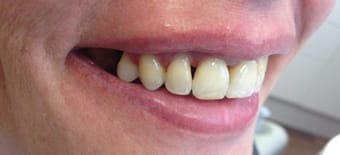 Before and After Invisalign Treatment Windsor Before and After Invisalign Treatment Windsor