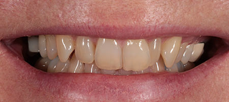 Composite Bonding Cases