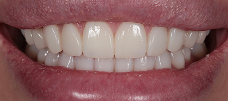 After Invisalign Treatment Reading Smiles