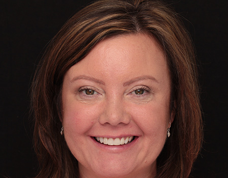 After Invisalign Treatment Reading Smiles