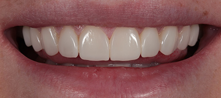 After Invisalign Treatment Reading Smiles