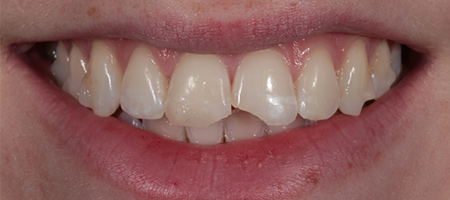 Composite Bonding Cases