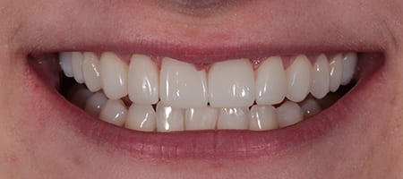 After Invisalign Treatment Reading Smiles