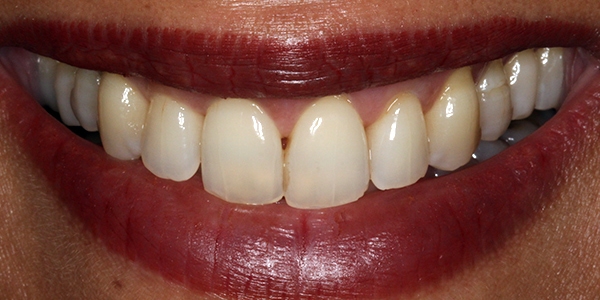 After Invisalign Treatment Reading Smiles