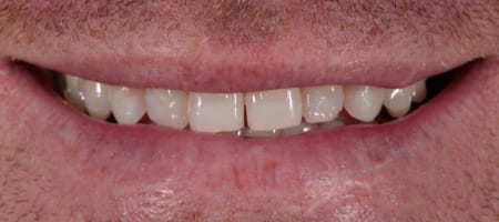 Composite Bonding Cases