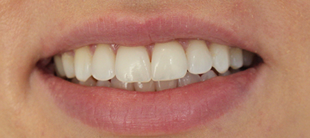 After Invisalign Treatment Reading Smiles