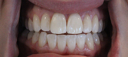 After Invisalign Treatment Reading Smiles