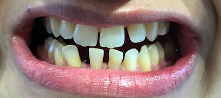 Before Invisalign Treatment Reading Smiles