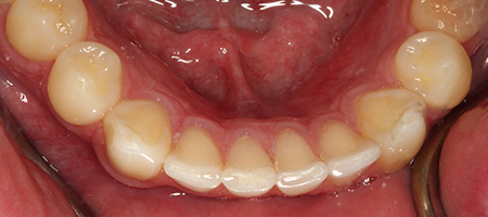 After Invisalign Treatment Reading Smiles