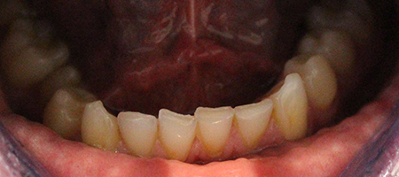 Before Invisalign Treatment Reading Smiles