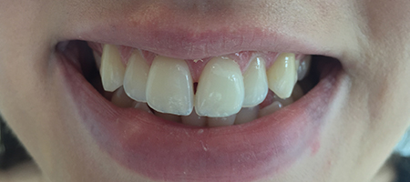 Before Invisalign Treatment Reading Smiles