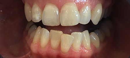 Before Invisalign Treatment Reading Smiles