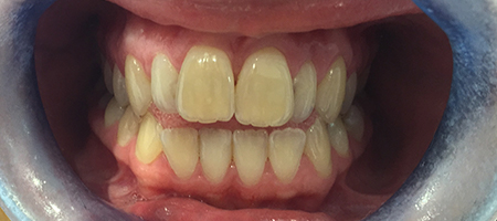 Before Invisalign Treatment Reading Smiles