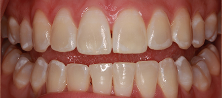 After Invisalign Treatment Reading Smiles