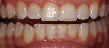 After Invisalign Treatment Reading Smiles