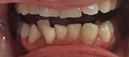 Before Invisalign Treatment Reading Smiles
