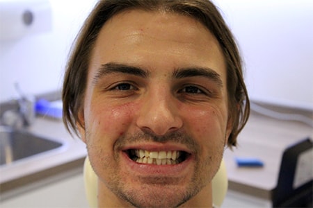 Before Invisalign Treatment Reading Smiles