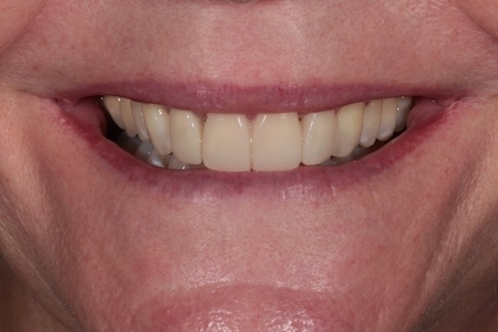 Before and After Invisalign Treatment Windsor Before and After Invisalign Treatment Windsor